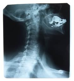 235_x ray personal injury lawyers Minnesota